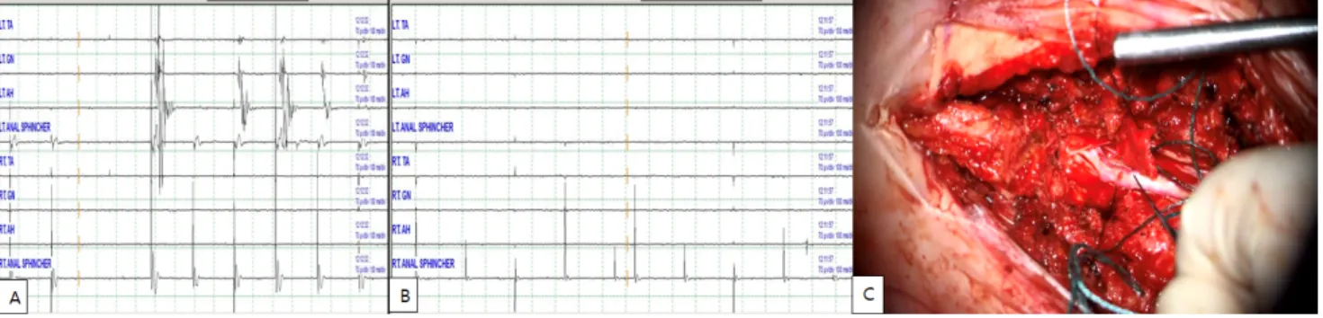 Figure  1.  Waves  of  direct  nerve  electrical  stimulation.