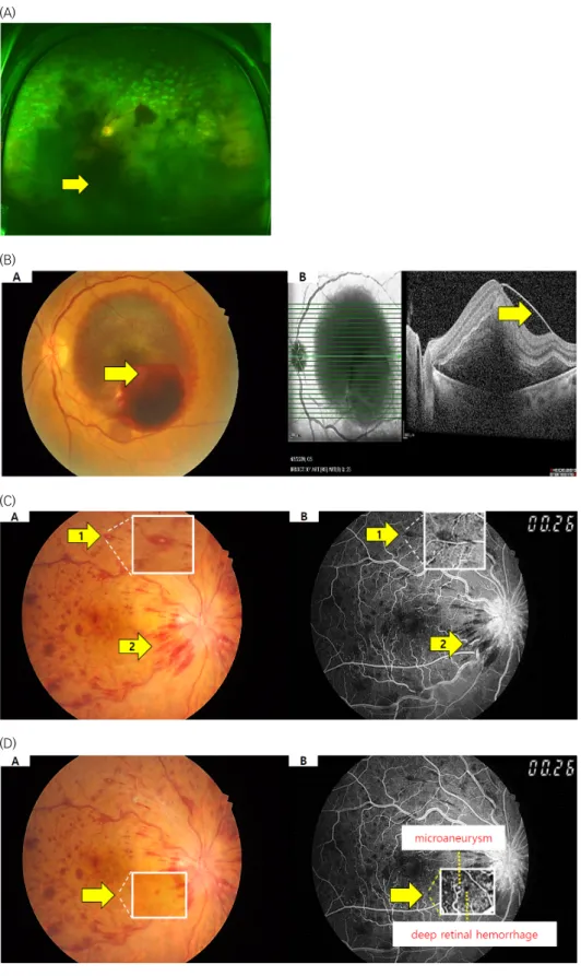 Figure  3.  (A)  Vitreous  hemorrhage: 