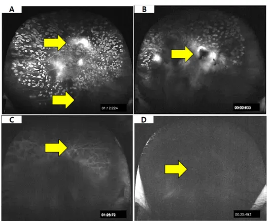 Figure  5.  A,  Clear  retinal  tissue  and  vascular  abnormalities  are  found  on  wide-angle fluorescent fundus  photo-graphs (Grade 1); B, Significant retinal  tissue  and  vascular  abnormalities  are  found on fluorescein angiograms (Grade  2);  C, 