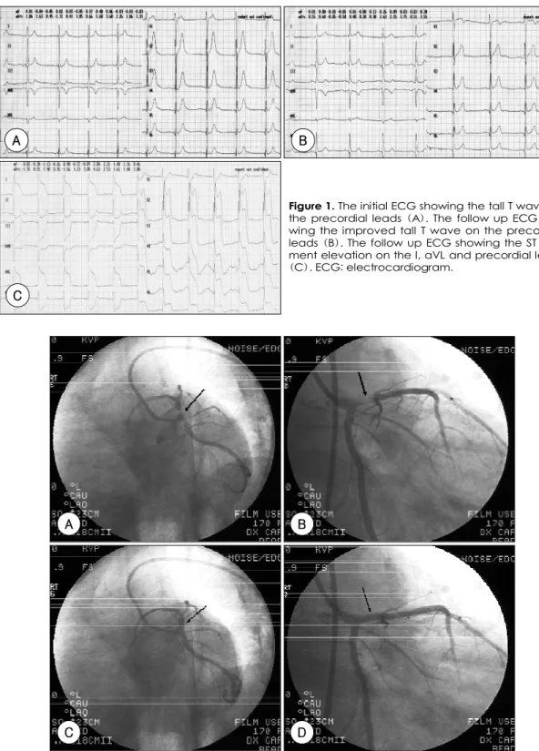 Figure 1. The initial ECG showing the tall T wave on the precordial leads (A). The follow up ECG  sho-wing the improved tall T wave on the precordial leads (B)