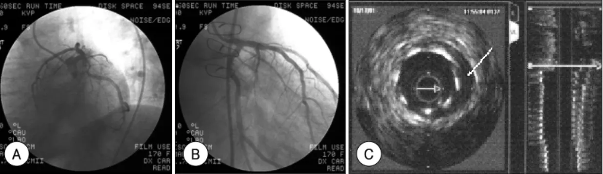 Figure 5. The computed tomography imaging showing dissection of the ascending aorta and descending aorta.