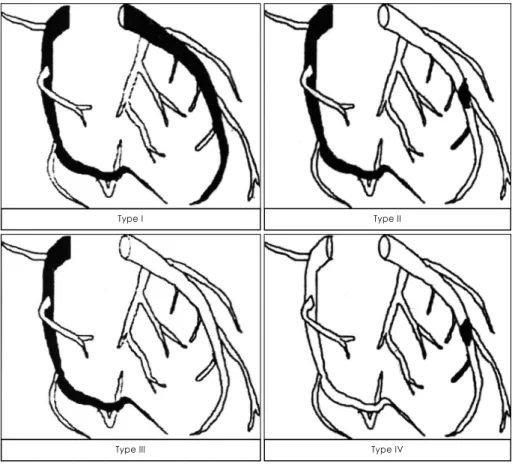 Fig. 1. Markis’ classfication for coronary artery ectasia. 10)