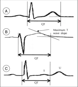 Fig. 1. Main QT measurement techniques. A：from beginning of the earliest QRS complex to return of the repolarization trace to the isoelectric line, B：from beginning of the earliest QRS complex to the  inte-rsection of a tangent to the downslpoe of the majo