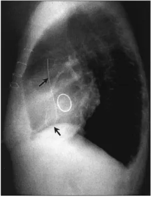 Fig. 4. Removed catheter fragment and loop snare. 
