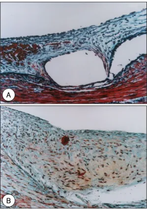 Fig. 1. Diagram shows the calculation method of area of neointima area and pathologic area stenosis (A).