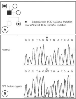 Fig. 2. Mutation detection in a family. A：pedigree of a family. B：DNA sequence analysis of genomic DNA identifies a G-to-T base substitution (arrow) in exon 28 of  SCN5A, leading to an amino acid substitution of valine by leucine at codon 1951 (V1951L)