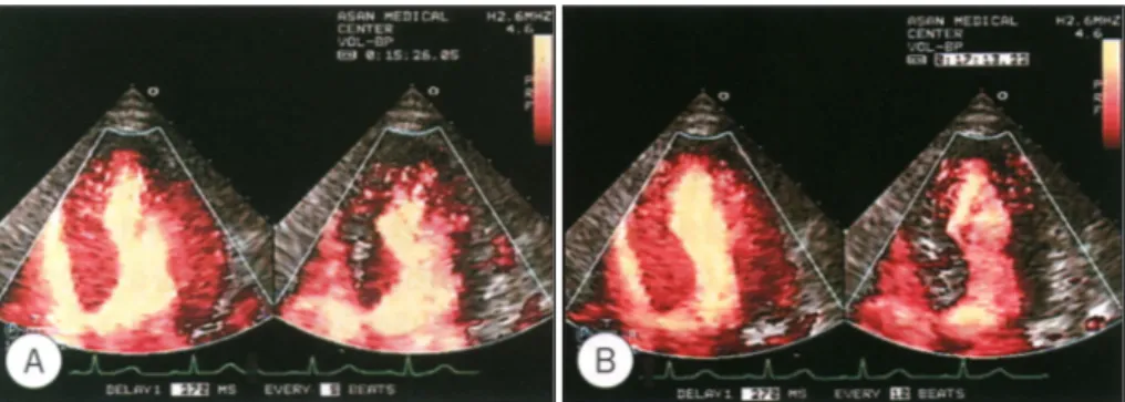 Fig. 1. Myocardial contrast echocardiography using power harmonic doppler imaging with multiple frame trigger (MFT)