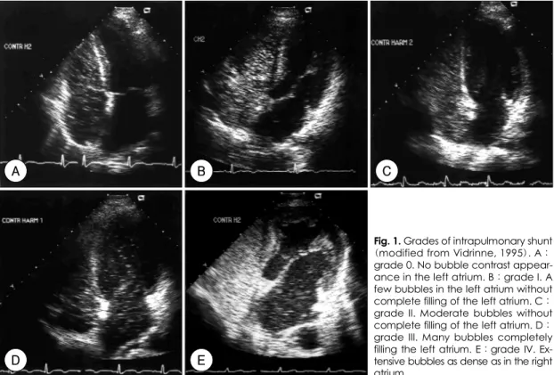 Fig. 1. Grades of intrapulmonary shunt (modified from Vidrinne, 1995). A：