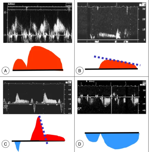 Fig. 2. Flow patterns of distal LAD immediate after AMI and their schematic representation