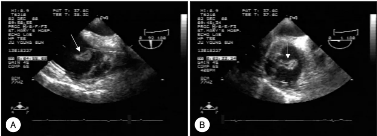 Fig. 4. Transesophageal echocardiographic findings (A, B), and surgically removed pacemaker leads with attached mass (C), and its pathologic finding (D), of 33-year old man with DDDR type permanent pacemaker for 3 years due to sick sinus syndrome and compl