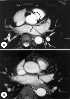 Fig. 2. Cardiac MRI image. A：acute angle takeoff of left main coronary artery due to clockwise rotation of coronary sinus