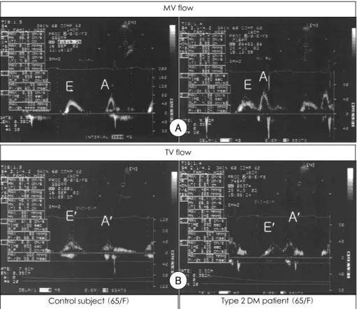 Fig. 1. Doppler-derived mitral and tricuspid flow patterns. 