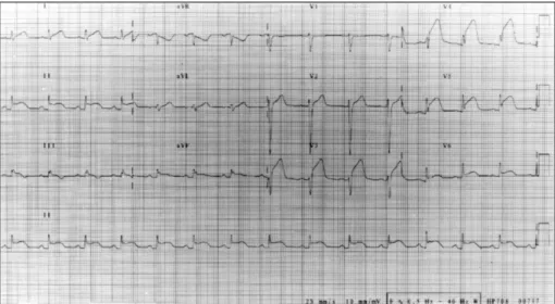 Fig. 1. An electrocardiogram showed marked ST-segment elevations in the leads of V  3-6 , I, II, III, and aVF on arrival at the emergency room