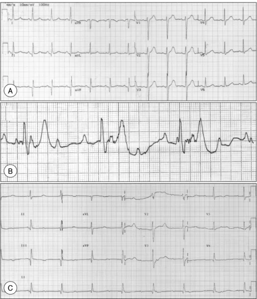 Fig. 1. A：resting 12-lead electrocardiogram shows the q-wave in the inferior leads and normal sinus rhythm on arrival, B：rhythm strip shows the complete heart block with escape ventricular rhythm of 38 bpm, C：follow-up  electrocard-iogram on 28th postopera
