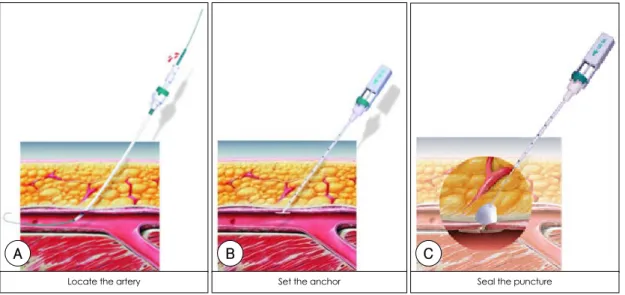 Fig. 1. Mechanism of Angio-Seal ®  device A：after catherization, the procedure sheath is replaced with the locator system