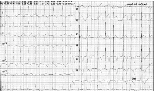 Fig. 1. Electrocardiogram  (ECG) shows sinus tachycardia, ST segment elevation without reciprocal change ( depression)in II, III, aVF, V1-V3, T wave inversion in I, aVL, V4-V6
