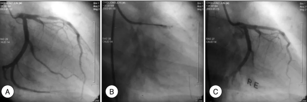 Fig. 1. A follow-up coronary angiogram revealed critical restenosis in the proximal left anterior descending artery (A) and successful percutaneous coronary intervention using balloon catheter (B)