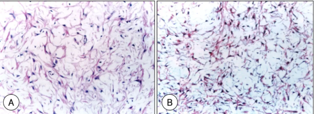 Fig. 3. An atherectomized tissues of coronary in-stent restenosis. Hematoxyllin &amp; Eosin stain (×200) shows myxoid tissue characterized by stellate smooth muscle cells in the loose extracellular matrix (A)