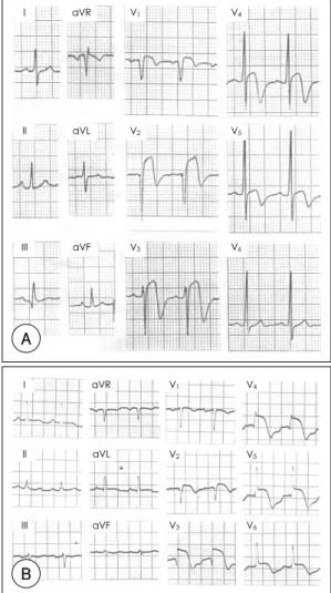 Fig. 1. An example of anterior wall acute myocardial in- in-farction (A) with or (B) without elevation of ST segment in lead V1