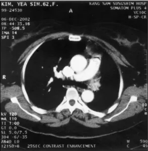 Fig. 2. Chest CT finding showed left pulmonary artery is absent and replaced by multiple collateral vessels from left bronchial artery, and right pulmonary artery is intact, aorta is normally positioned in the left side