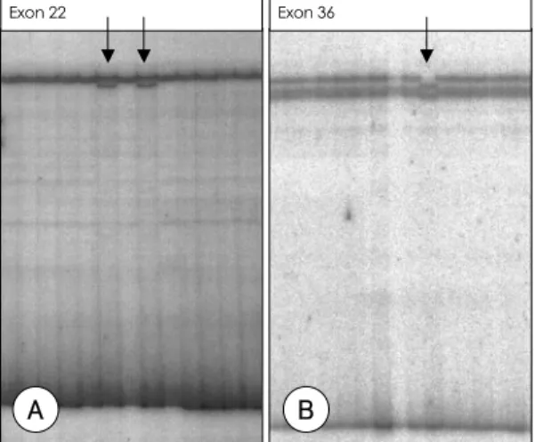 Fig. 2. Mutation detection by SSCP-heteroduplex in Mar- Mar-fan patients. Single strand DNA has tendency to fold up an complex structure and the electrophoretic mobility of single strand DNA on non-denaturing gels depends on the length and the conformation