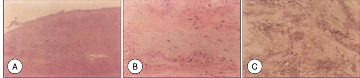 Fig. 3. Typical pathologic findings of Marfan patients. A：H &amp; E stain of histologic section of aorta at low power (×