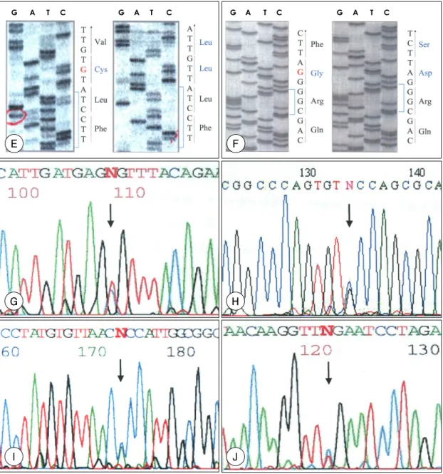 Fig. 4. Electropherograms mutations. A：patient 1 carried a C to T substitution corresponding to a Arg to Stop substi- substi-tution on exon 9
