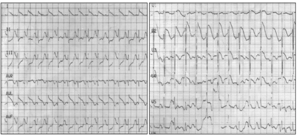 Fig. 2. Electrocardiography on admission, showing ST segment elevation on lead I, aVL, V2, V3