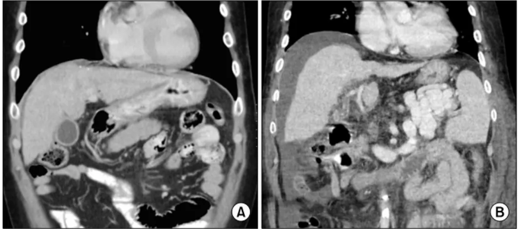 Fig. 2. Abdominal computed tomography (CT) scans before and after dexamethasone treatment