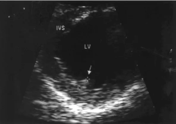 Fig. 2. Apical two chamber view of LV. Mitral valve shows the restricted motion of mitral leaflets with mild thickening of valvular structure