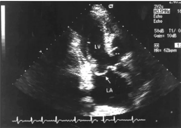 Fig. 4. Cardiac MRI short axis view showed underdevelo- underdevelo-ped posteromedial papillary muscle(arrow)