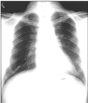 Fig. 5. Chest X-ray after discharge reveals normal sized  cardiac shadow. 