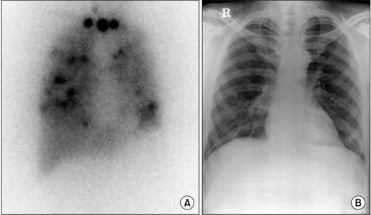 Fig.  1.  Post-therapeutic  I-  131  scan  (A)  and  Chest  radiograph  (B)  of  48  yr-old  male  patient  with   differen-tiated  thyroid  cancer