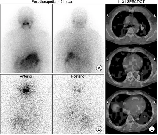 Fig.  2.  Post-therapeutic  I-  131  scan  at  3  day  (A)  and 7 day (B), and SPECT/CT (C) after  high  dose  I-131   the-rapy in  52 yr-old male  pat-ient  underwent  total   thyroi-dectomy and radioiodine  ab-lation  due  to  differentiated  thyroid  ca