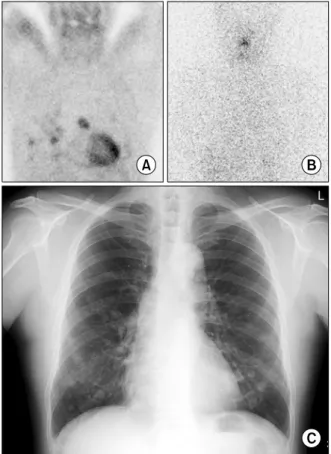 Fig.  3.  Tc-99m  MIBI  whole  body  scan  (A),  post-therapeutic I-131  scan  (B)  and  Chest  PA  (C)  in  57  yr-old  male  patient with  differentiated  thyroid  cancer