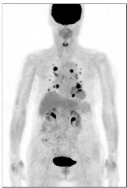 Fig.  4.  F-18  FDG  PET/CT  in  81  yr-old  female  patient  with  differentiated  thyroid  cancer