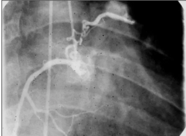 Fig. 3. Fistulas draining into anterior portion of pulmonary  trunk with aneurysmal dilatation at entering site