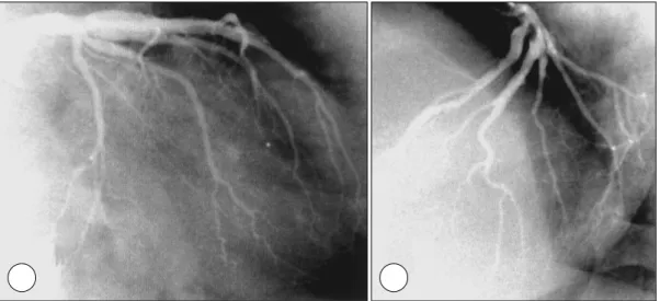 Fig. 2. Initial left coronary angiogram (RAO-caudal (A) and LAO-cranial (B)) revealed no significant ectatic ch- ch-ange or stenosis on left anterior descending artery and left circumflex artery