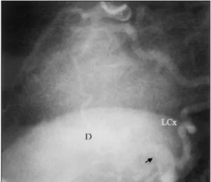 Fig. 2. Selective right coronary angiogram. On the left  lateral projection, the right coronary artery is  communi-cated directly with the left ventricle via common  cha-nnel (arrow), with faint visualization of the left circumflex  coronary artery and the