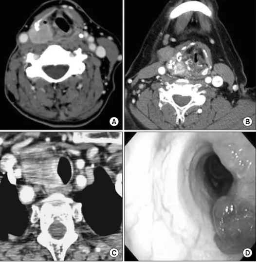 Fig.  1.  Images  of  laryngo- laryngo-tracheal  invasion  of  thyroid  cancer.  (A)  CT  finding  of  primary papillary thyroid  can-cer  invading  the  paraglottic  space  via  direct  invasion  to  the posterior thyroid cartilage ala