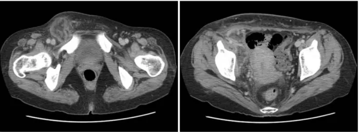 Fig.  2.  Abdomen  CT  showed  irregular,  rim  enhanced  lesions  at  right  inguinal  area  and  right  pelvic  extraperitoneal  space.