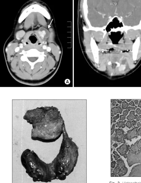 Fig.  2.  Surgical  specimen  shows  that  thyroglossal  duct  cyst mass attached hyoid bone and connected to left thyroid lobe specifically