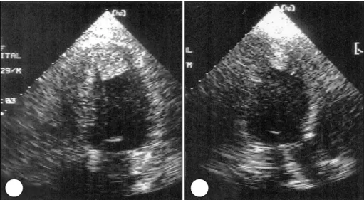 Fig. 4. Left (A) and right (B) coronary angiograms show no significant stenosis in coronary arteries