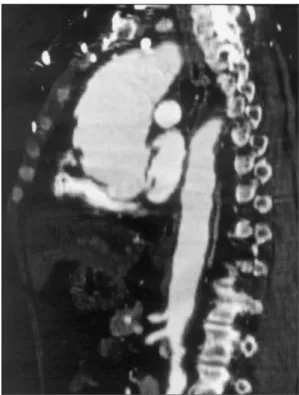 Fig. 2. Two-dimensional echocardiographic parasternal long-axis view showing markedly dilated ascending  ao-rta with a diameter of 55.1 mm