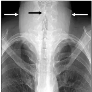 Fig.  1.  Simple  chest  X-ray  demonstrated  huge  neck  mass  contour  (white  arrows),  and  slight  trachea  narrowing  (black  arrow).