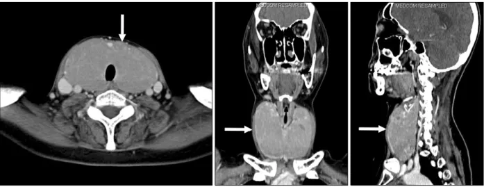 Fig.  2.  Computed  tomography  showed  diffusely  enlarged  thyroid  gland  around  the  entire  neck  (white  arrows).