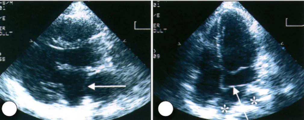 Fig. 1. Transthoracic echocardiograms demonstrating an abnormal membrane-like structure (arrows at A and B) in left atrium