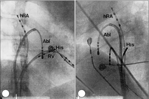 Fig. 1. The fluoroscopic image of intracardiac electrode catheters. Multipolar electrode catheters were positioned in high right atrium (hRA), His bundle area (His) across the tricuspid valve, coronary sinus, and the right  ventri-cular apex (RV)