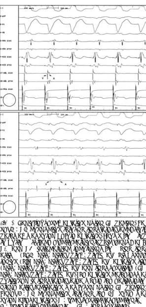 Fig. 3. Panel A：surface electrocardiogram before ra- ra-diofre-quency ablation. Delta wave was seen