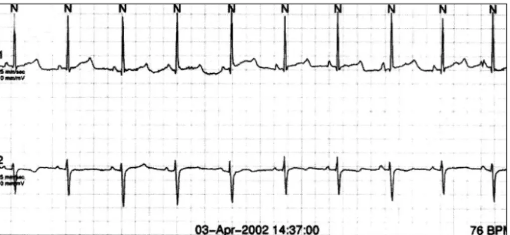 Fig. 3. T wave alternans. Alternation of the T wave amplitude and polarity was recorded during Holter monitoring (patient 8)